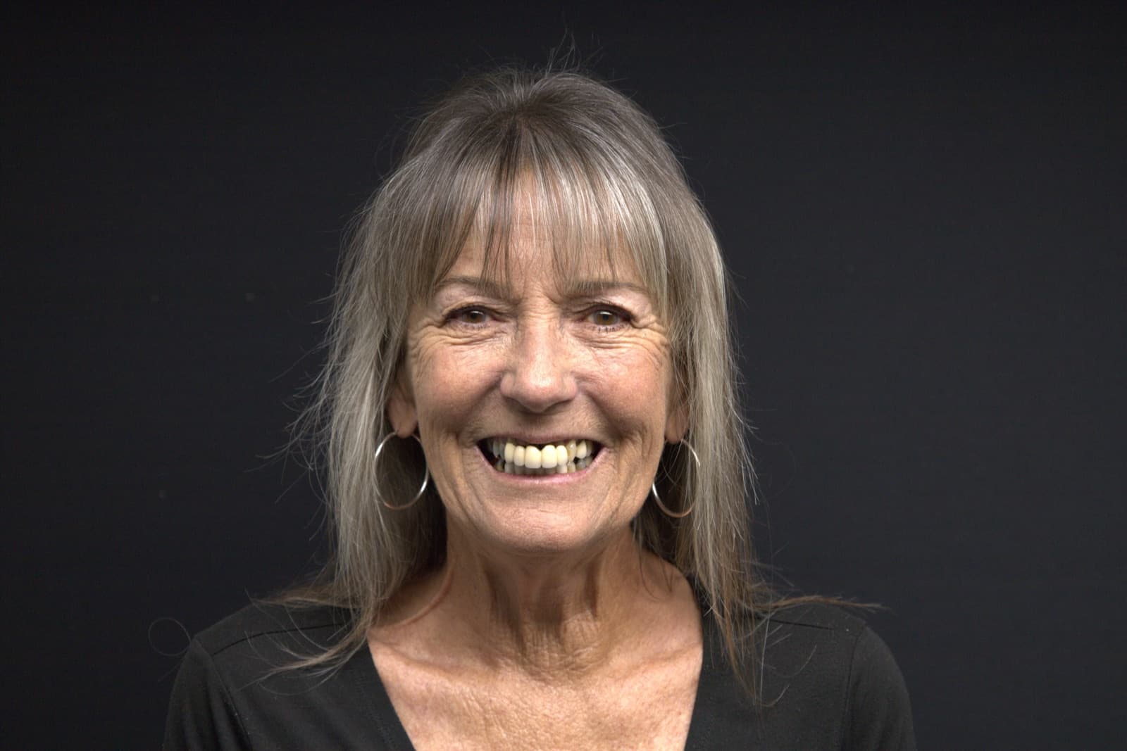 Full-mouth dental implant patient before treatment